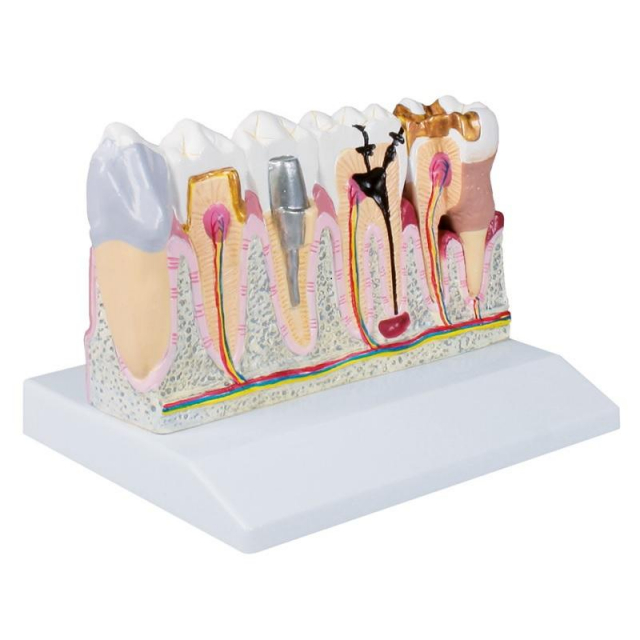 Dentalmodell 4-fache Größe