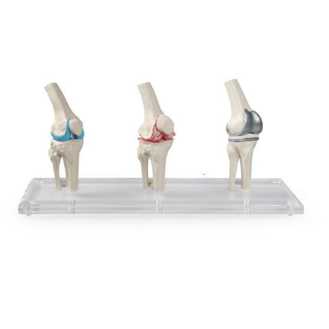 Knie-Implantat-Modell 3-teilig