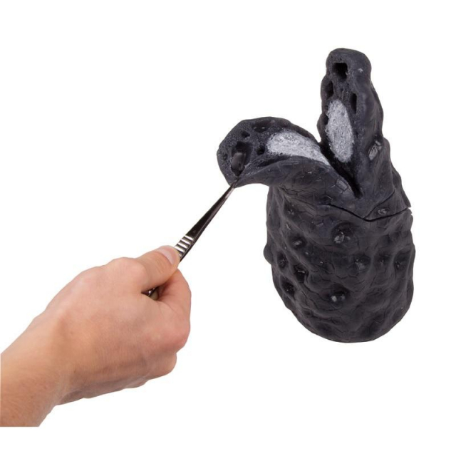 Lungenkrebs-Modell
