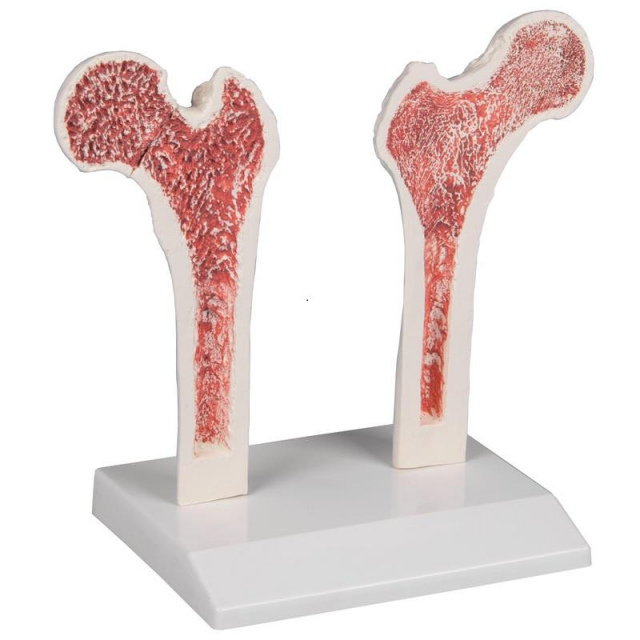Osteoporose-Oberschenkel mit abnehmbarem Stativ