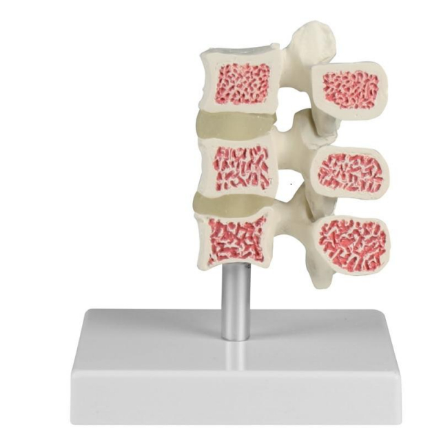 Osteoporose-Wirbel-Modell 3 Wirbel